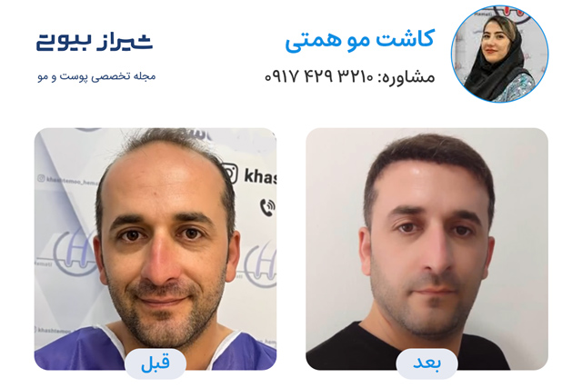 کاشت مو در شیراز - کاشت همتی