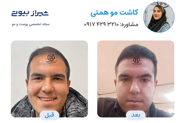 کاشت مو در شیراز - کاشت همتی