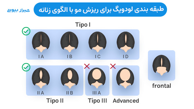 طبقه بندی لودویگ برای ریزش مو با الگوی زنانه