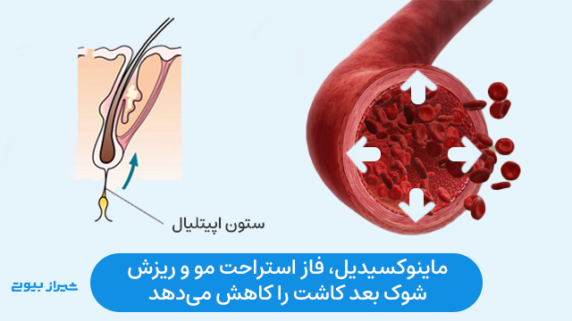 ماینوکسیدیل، فاز استراحت مو و ریزش شوک بعد کاشت را کاهش می‌دهد.