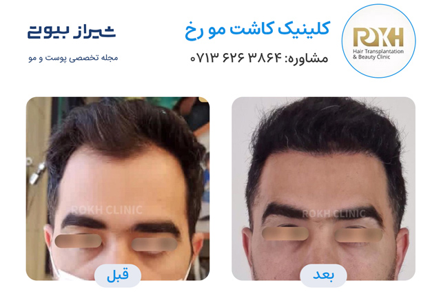 کاشت مو در شیراز - کلینیک رخ