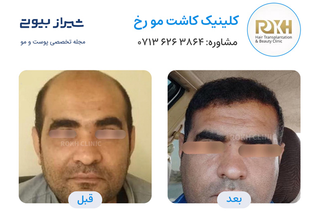 کاشت مو در شیراز - کلینیک رخ