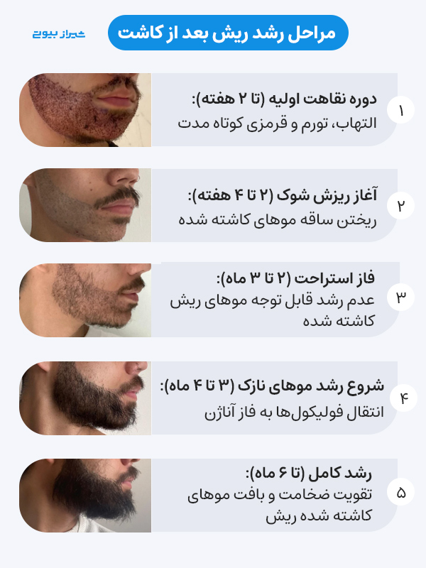 مراحل رشد ریش بعد از کاشت