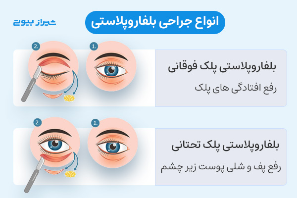 انواع جراحی بلفاروپلاستی: بلفاروپلاستی پلک فوقانی (بالا)، بلفاروپلاستی پلک تحتانی (پایین)