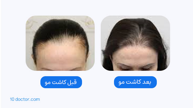کاشت موی جلوی سر برای خانمها - تصاویر