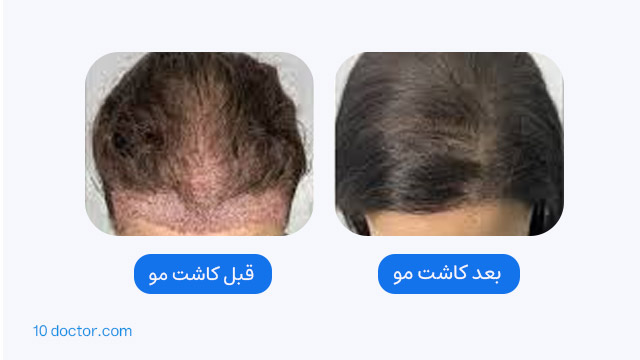 کاشت موی جلوی سر برای خانمها - تصاویر