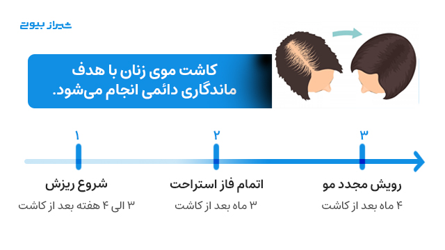 کاشت موی زنان با هدف ماندگاری دائمی انجام می‌شود.