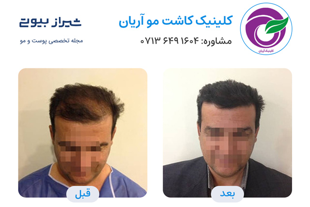 کاشت مو در شیراز - کلینیک آریان