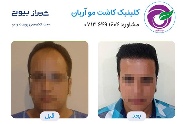 کاشت مو در شیراز - کلینیک آریان
