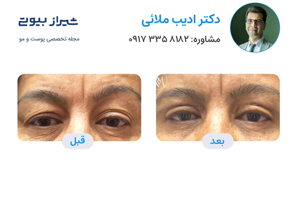 بلفاروپلاستی در شیراز - دکتر ادیب ملائی