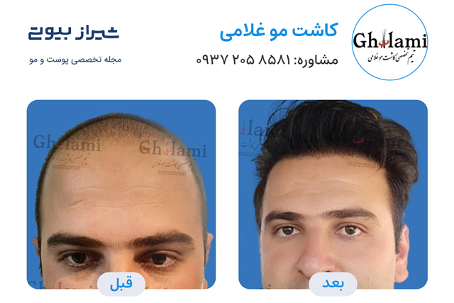 کاشت مو در شیراز - کاشت غلامی