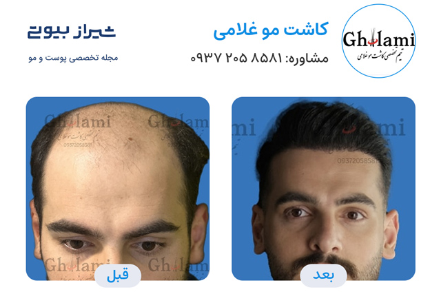کاشت مو در شیراز - کاشت غلامی