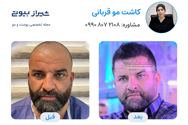 کاشت مو در شیراز - کاشت قربانی