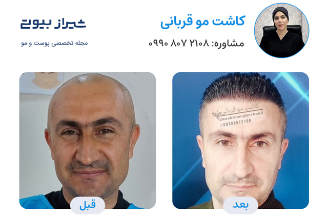 کاشت مو در شیراز - کاشت قربانی