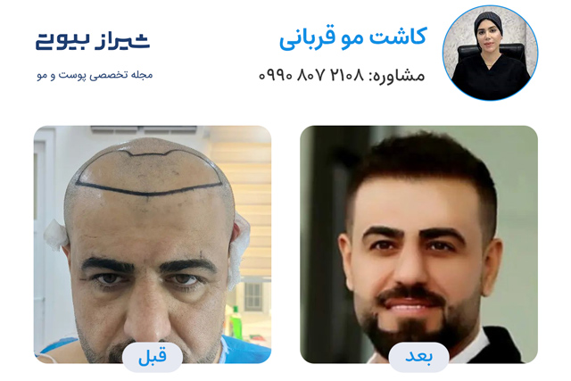 کاشت مو در شیراز - کاشت قربانی