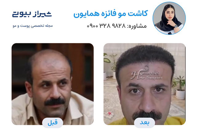 کاشت مو در شیراز - کاشت همایون