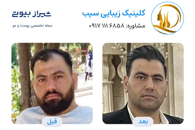 کاشت مو در شیراز - کلینیک سیب