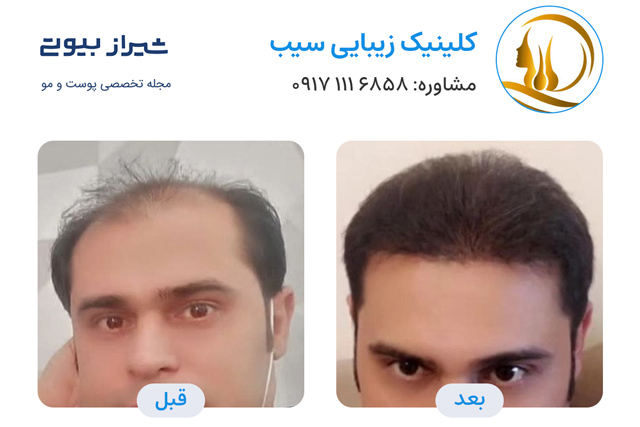 کاشت مو در شیراز - کلینیک سیب