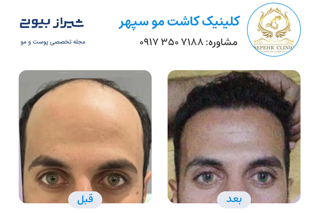 کاشت مو در شیراز - کلینیک سپهر