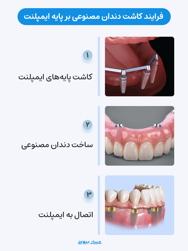 فرایند کاشت دندان مصنوعی بر پایه ایمپلنت