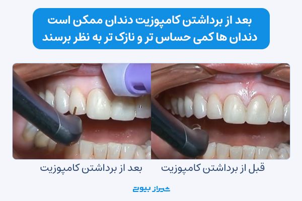 عکس قبل و بعد برداشتن و ریمو کامپوزیت دندان