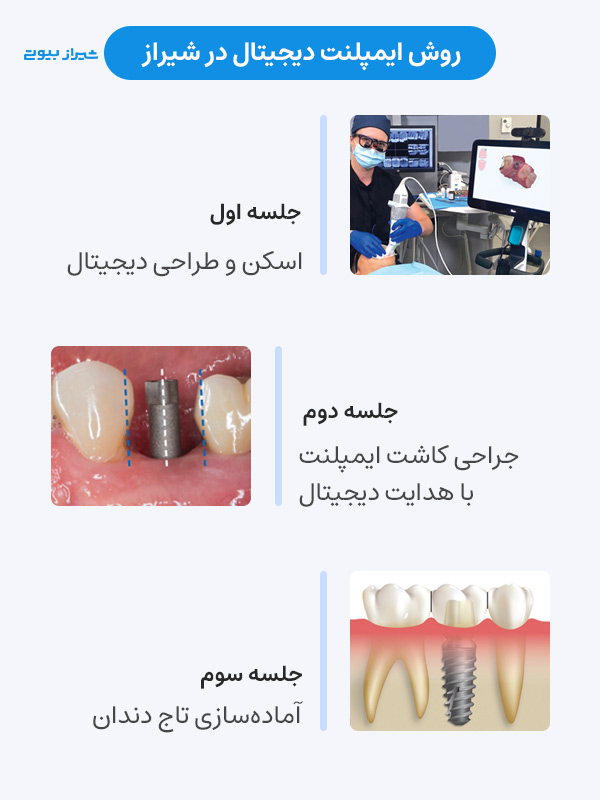 روش ایمپلنت دیجیتال در شیراز