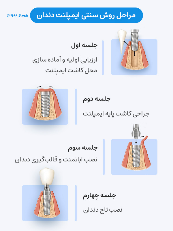 روش سنتی ایمپلنت دندان در شیراز