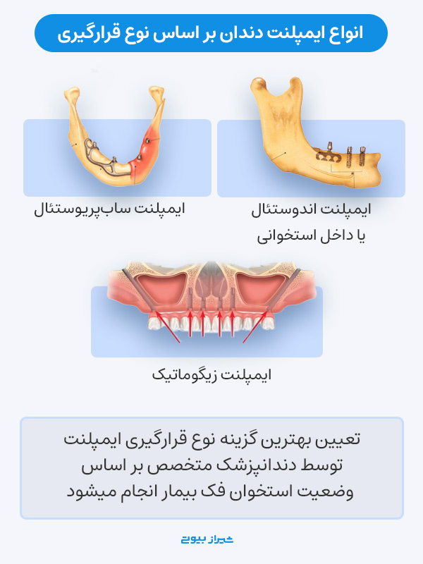 انواع ایمپلنت دندان بر اساس نوع قرارگیری در فک