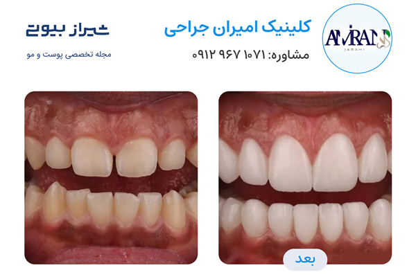 لمینت دندان در شیراز - کلینیک امیران جراحی
