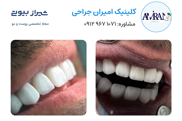 لمینت دندان در شیراز - کلینیک امیران جراحی