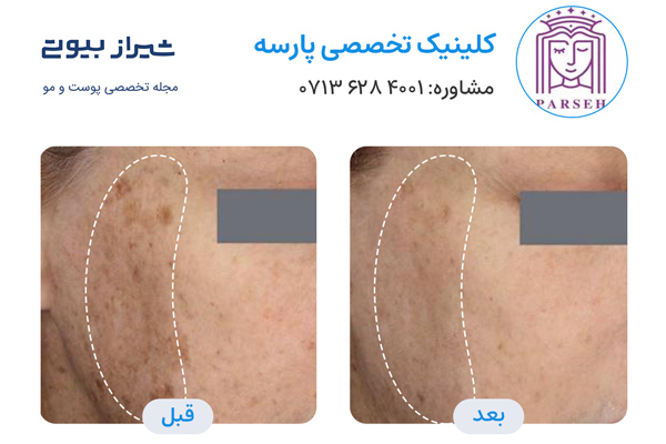تصاویر قبل و بعد لیزر جای لک و جوش در شیراز کلینیک پارسه