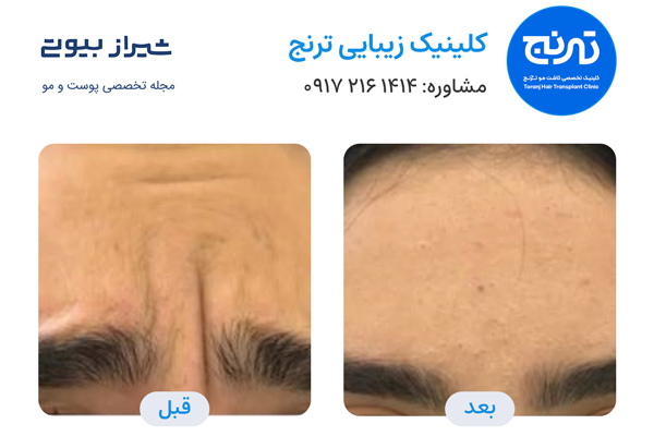 بوتاکس در شیراز - کلینیک ترنج