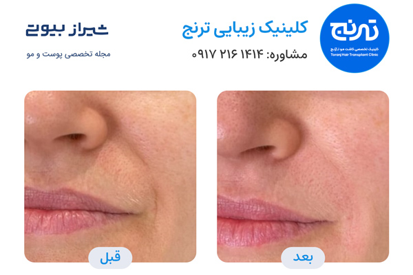 بوتاکس در شیراز - کلینیک ترنج