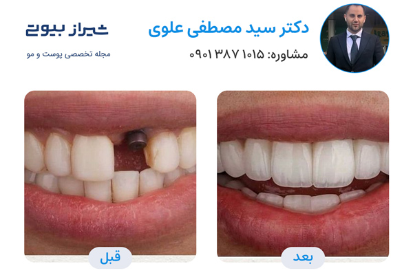 بهترین دکتر ایمپلنت در شیراز - دکتر مصطفی علوی