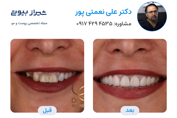 لمینت دندان در شیراز - دکتر علی نعمتی پور