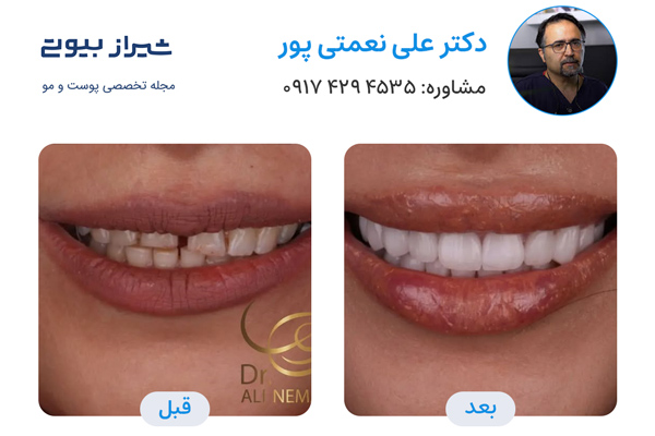 لمینت دندان در شیراز - دکتر علی نعمتی پور