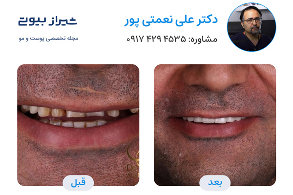 لمینت دندان در شیراز - دکتر علی نعمتی پور