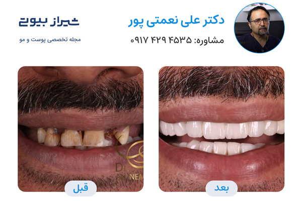 لمینت دندان در شیراز - دکتر علی نعمتی پور
