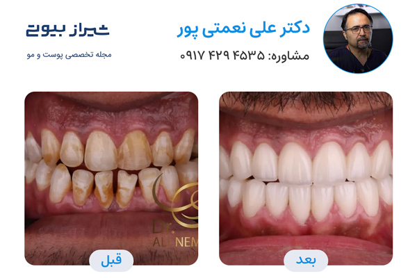 لمینت دندان در شیراز - دکتر علی نعمتی پور