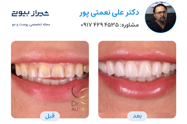 لمینت دندان در شیراز - دکتر علی نعمتی پور