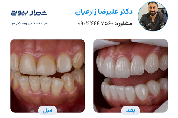 لمینت دندان در شیراز - دکتر علیرضا زارعیان