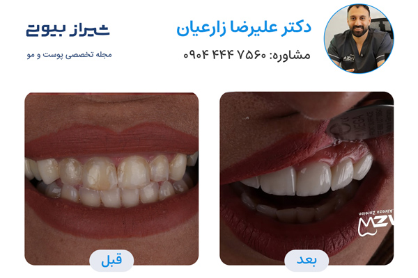 لمینت دندان در شیراز - دکتر علیرضا زارعیان