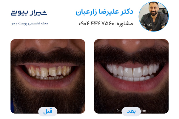 لمینت دندان در شیراز - دکتر علیرضا زارعیان