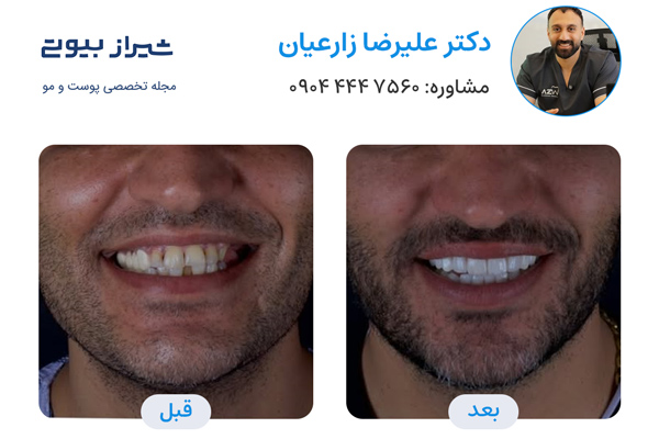لمینت دندان در شیراز - دکتر علیرضا زارعیان