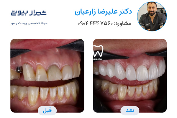 لمینت دندان در شیراز - دکتر علیرضا زارعیان
