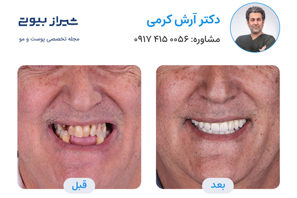 ایمپلنت دندان در شیراز - دکتر آرش کرمی