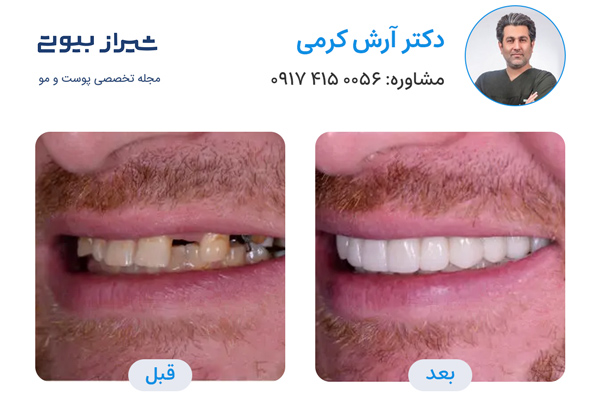 ایمپلنت دندان در شیراز - دکتر آرش کرمی
