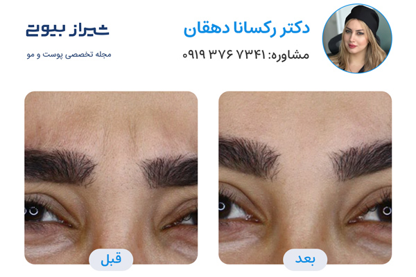 بهترین دکتر بوتاکس در شیراز - دکتر رکسانا دهقانی
