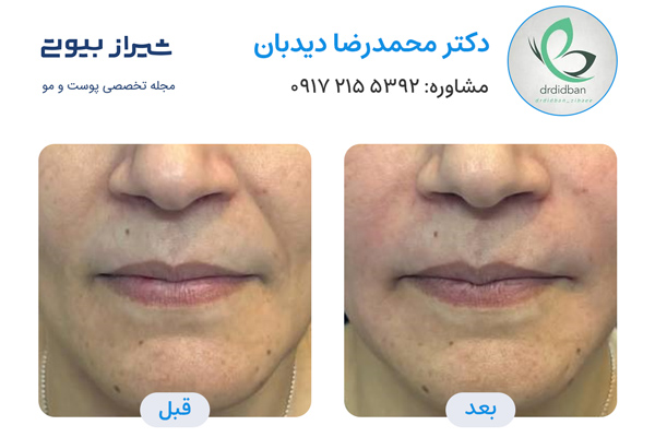 بوتاکس در شیراز - دکتر محمدرضا دیدبان