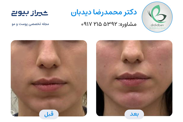بوتاکس در شیراز - دکتر محمدرضا دیدبان